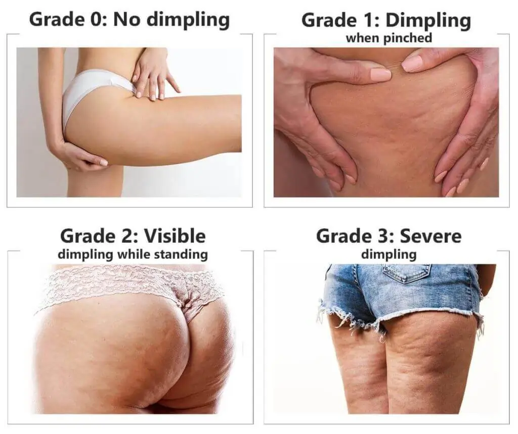 Representation of the stages of cellulite development Houghton Regis